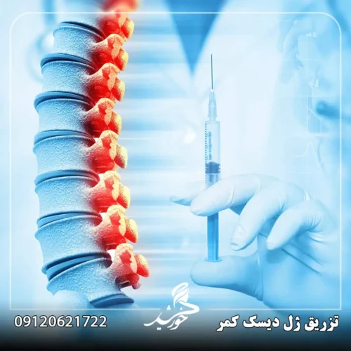 تزریق ژل به دیسک کمر