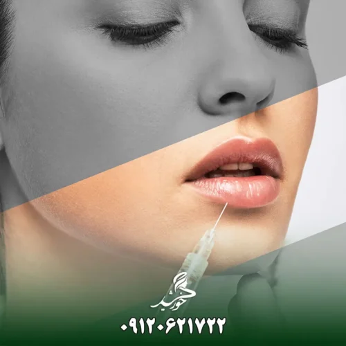 تزریق ژل روسی