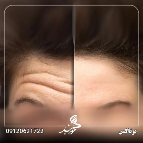 بوتاکس چیست؟