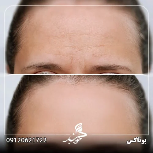 نحوه عملکرد بوتاکس
