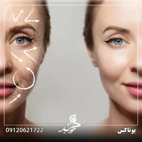 مزایای فرآیند بوتاکس
