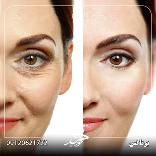 مراحل تزریق بوتاکس: آمادگی، انجام و مراقبت‌های پس از درمان