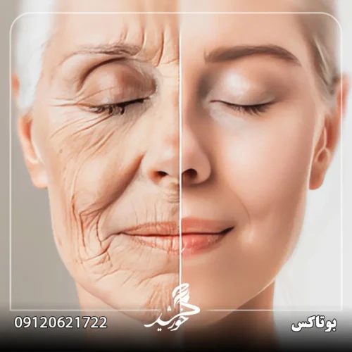 کاندیدای مناسب برای تزریق بوتاکس