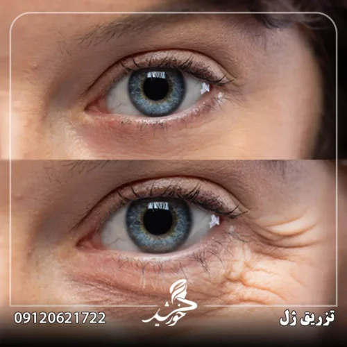 رفع افتادگی پوست با ژل