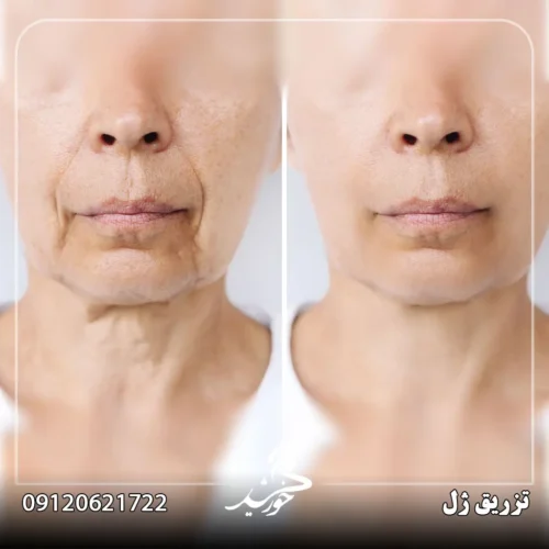 رفع افتادگی با تزریق ژل
