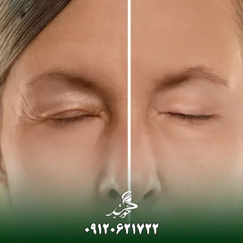 بلفاروپلاستی چگونه است؟