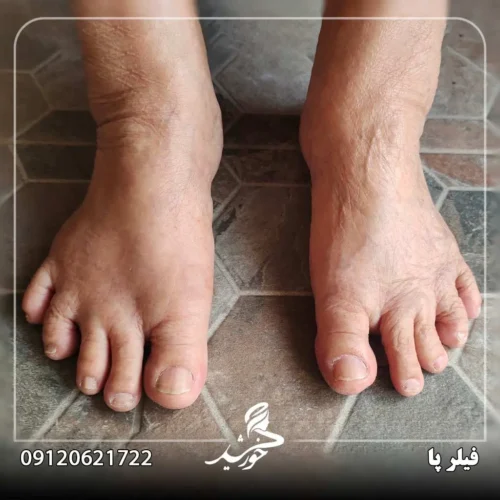 کسانی که به تزریق ژل و فیلر پا نیاز دارند