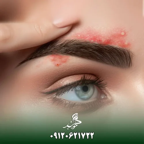 چرا پس از کاشت ابرو جوش میزنیم و چگونه آن را درمان کنیم؟