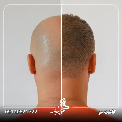 راهکارهای مؤثر برای جلوگیری از ورم پس از کاشت مو