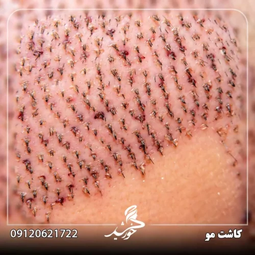 راهکارهای مؤثر برای جلوگیری از ورم پس از کاشت مو