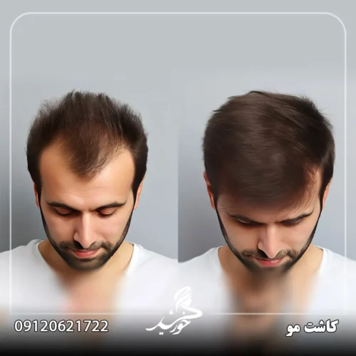 تجربه حرفه‌ای کاشت مو در کلینیک خورشید