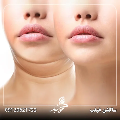 تاثیر ساکشن غبغب آیا دائمی است؟