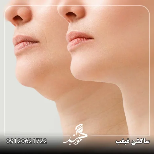 ساکشن غبغب در کلینیک خورشید