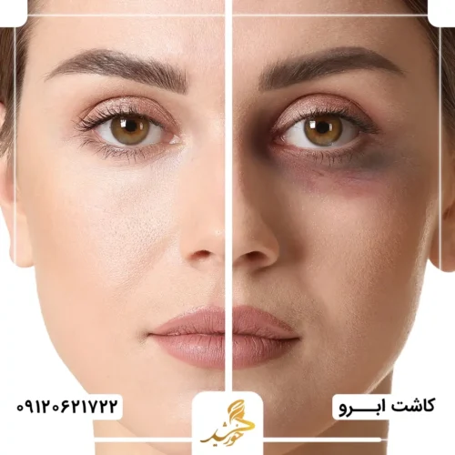 بروز کبودی اطراف چشم به دلیل کاشت ابرو در محیط غیربهداشتی با تجهیزات قدیمی