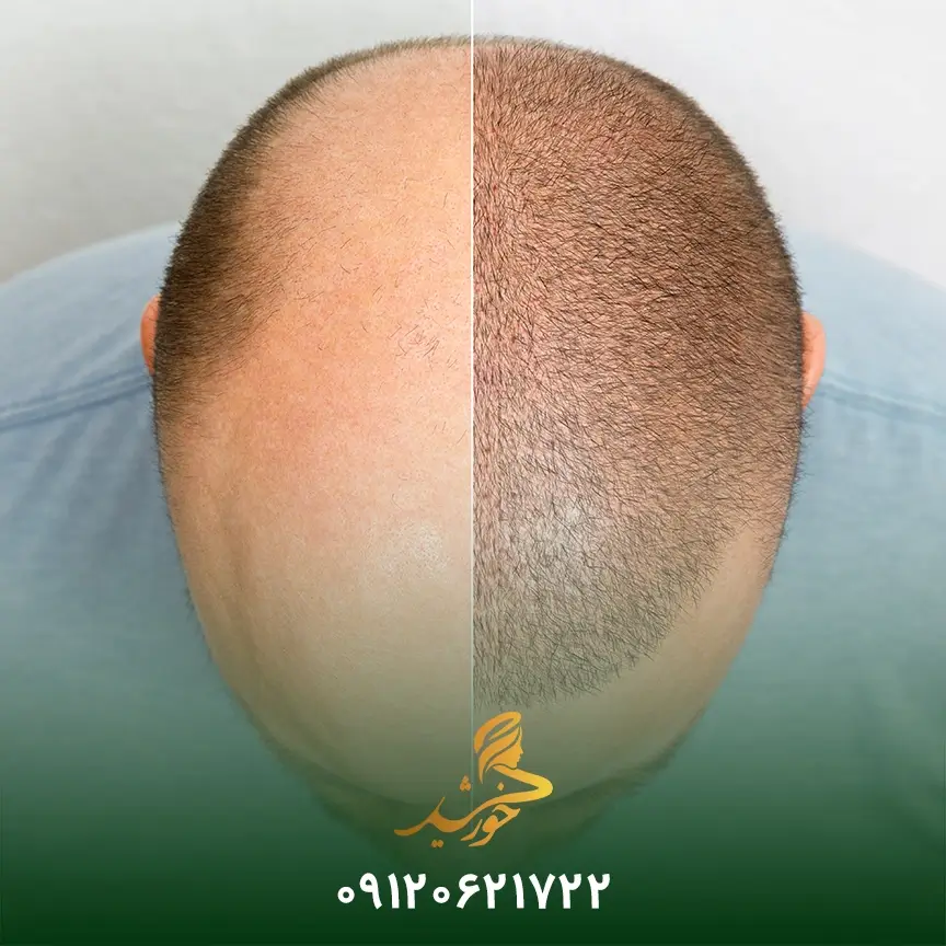 مشکلات خوابیدن به پهلو پس از کاشت مو