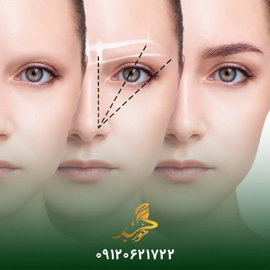 ورزش بعد از کاشت ابرو