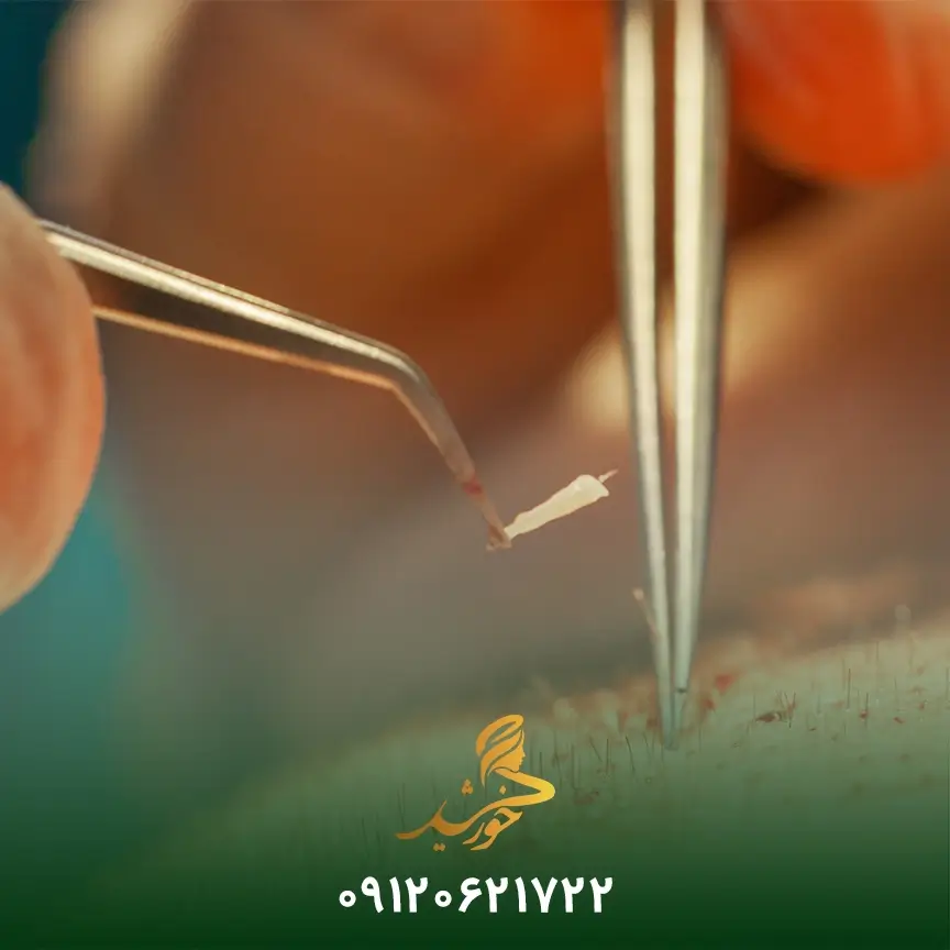 پیوند مو با سلول بنیادی