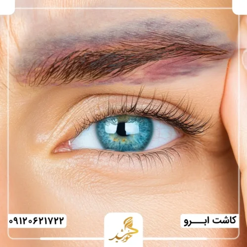 کبودی پس از کاشت ابرو به دلیل حساسیت به ماده بی‌حسی