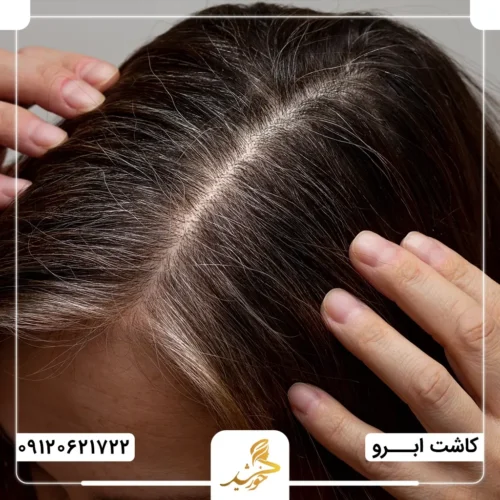 بررسی تطابق ضخامت موهای اهدایی و موهای ناحیه دریافت‌کننده برای کاشت ابرو