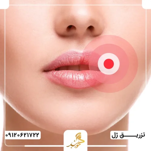 تورم لب به دلیل واکنش طبیعی بدن به تزریق ژل