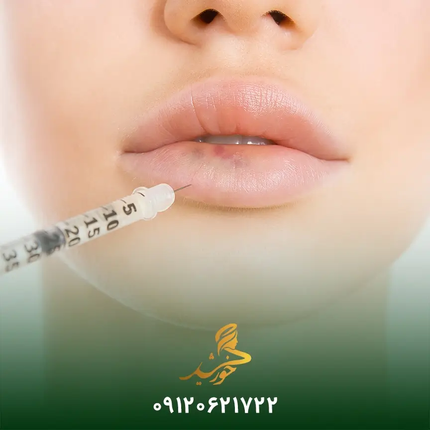 درمان کبودی پس از تزریق ژل