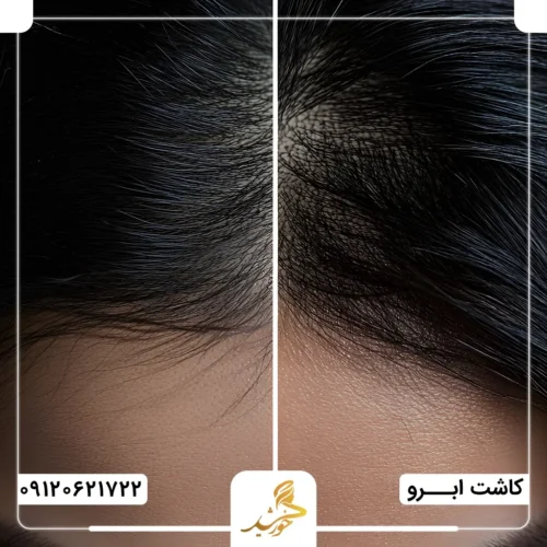 کاشت ابرو با هر نوع بانک مویی در کلینیک زیبایی خورشید