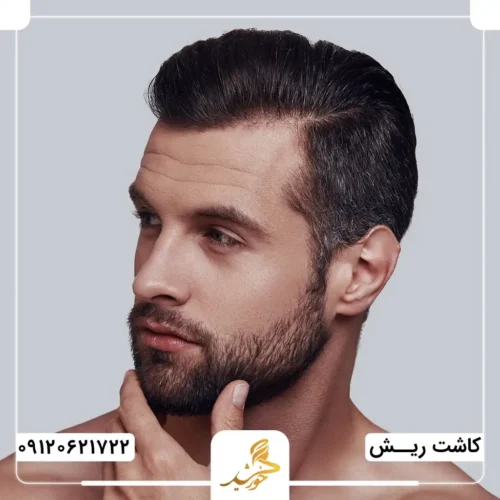 برتری کاشت ریش به روش میکروگرافت بر سایر روش‌ها