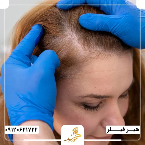 بررسی تفاوت محدودیت‌های هیر فیلر و مزوتراپی