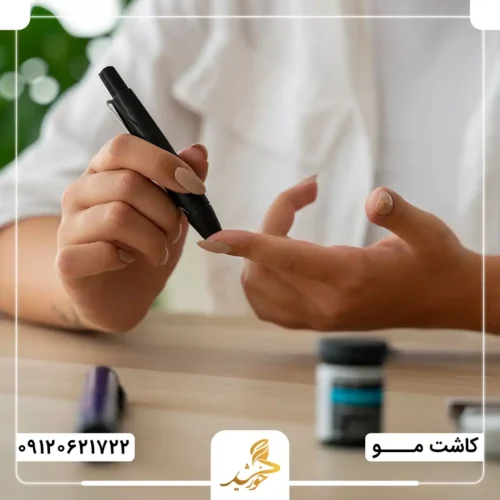 بهترین روش کاشت مو برای دیابتی‌ها کدام است؟