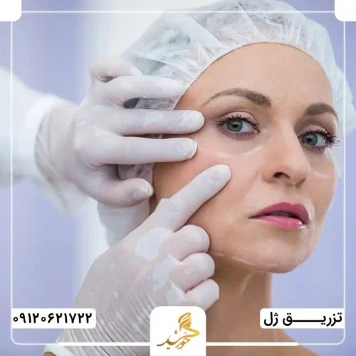 تأثیرات ژل هیالورونیک اسید روی گونه
