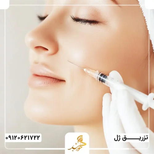 تزریق ژل بعد از هایفو تراپی