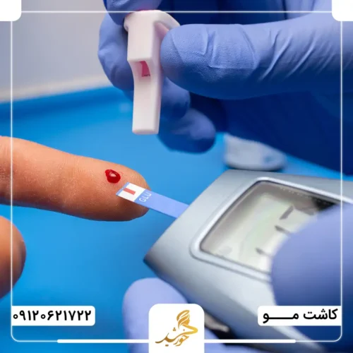 دیابت نوع ۱ و کاشت مو