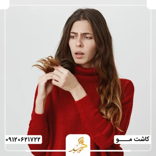 دیابت و ریزش موها