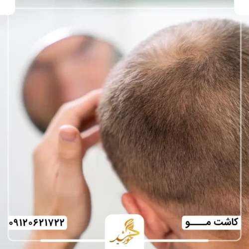 مراقبت‌های مهم پس از کاشت مو برای دیابتی‌ها