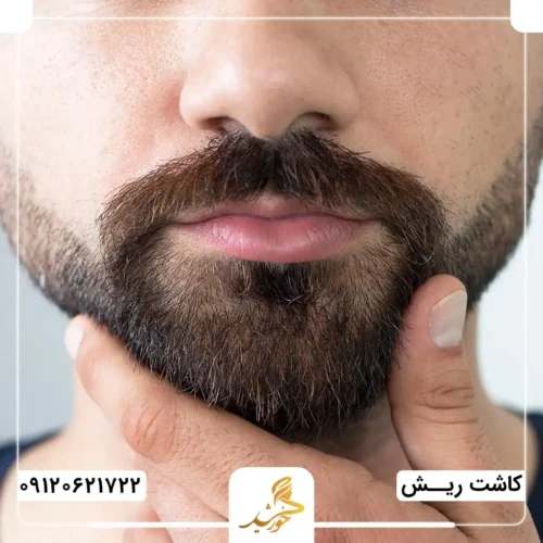 کاشت ریش به روش میکروگرافت در کلینیک زیبایی خورشید