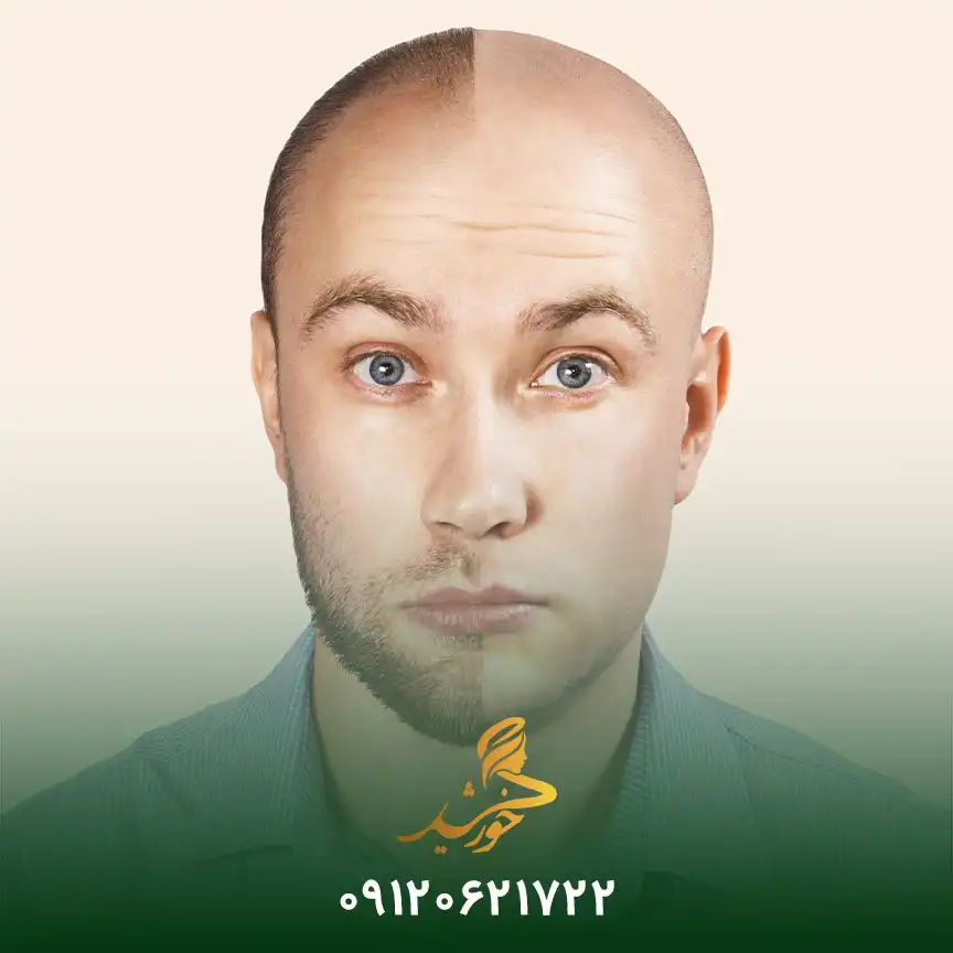 کاشت و پیوند ریش به روش میکروگرافت