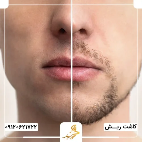 کاندیدای مناسب برای کاشت ریش به روش میکروگرافت