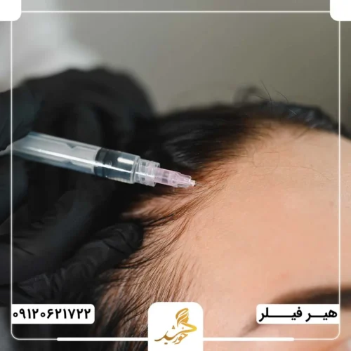 تزریق هیرفیلرهای باکیفیت در کلینیک زیبایی خورشید
