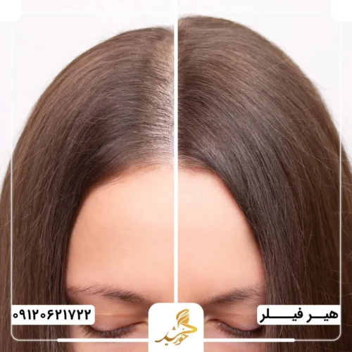 جلوگیری از ریزش مو با تزریق هیرفیلر