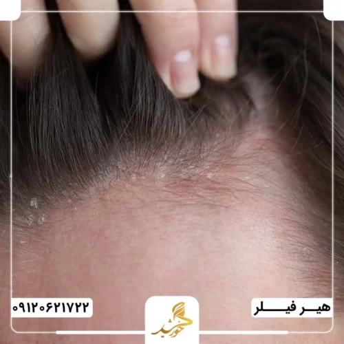 رفع مشکلات مربوط به پوست کف سر با تزریق هیرفیلر