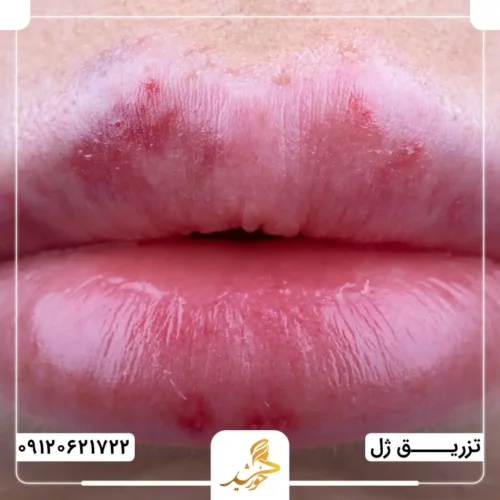 احتمال ایجاد اسکار در اثر تزریق نادرست ژل لب