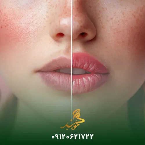 ضررهای تزریق ژل لب