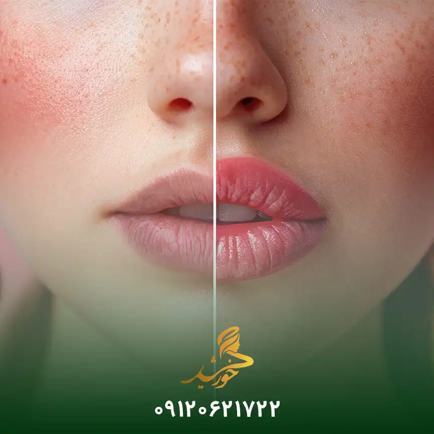 ضررهای تزریق ژل لب