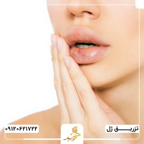کبود شدن لب‌ها در اثر تزریق ژل