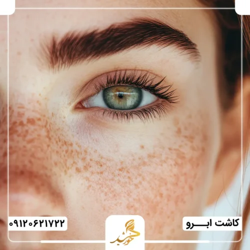 بهبود پوسته پوسته شدن ناحیه ابروهای کاشته شده با مصرف پماد مناسب