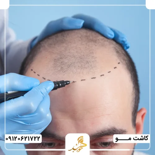 بهترین روش کاشت مو در پیشانی بلند