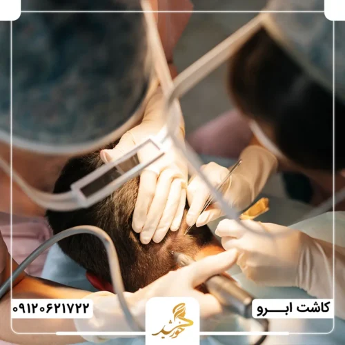 روش کاشت ابرو بدون جراحی