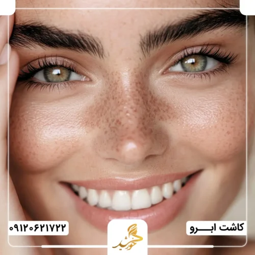 ماندگاری نتایج پیوند ابرو بدون جراحی