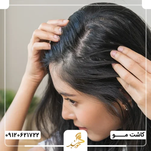 محدودیت های انجام پیوند مو در پیشانی بلند