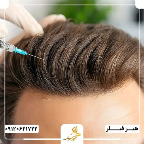 مزایای تزریق فیلر مو